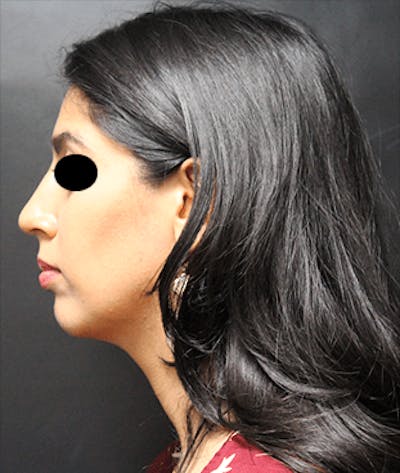 Rhinoplasty Before & After Gallery - Patient 25139804 - Image 2