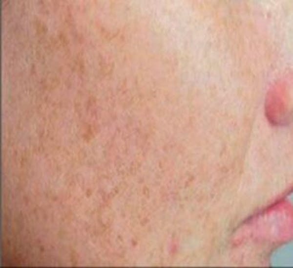 IPL Treatment Before & After Gallery - Patient 25139820 - Image 1