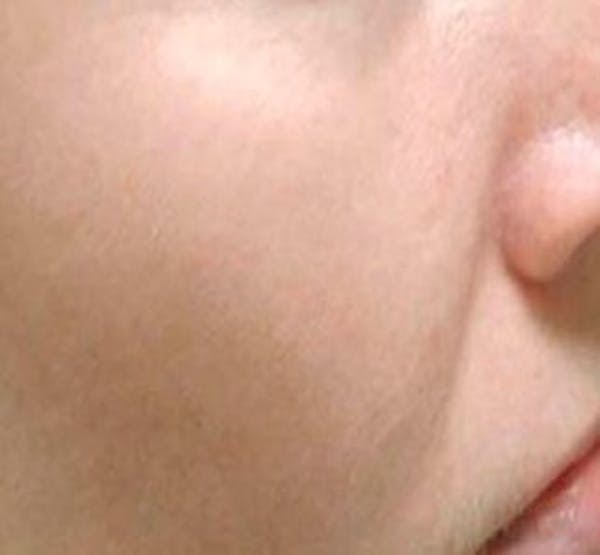 IPL Treatment Before & After Gallery - Patient 25139820 - Image 2