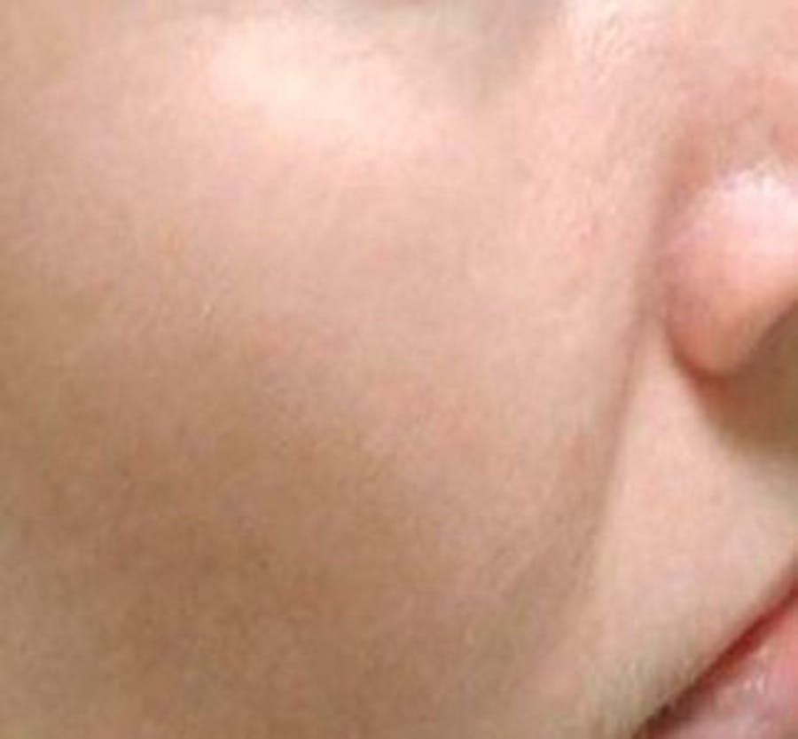 IPL Treatment Before & After Gallery - Patient 25139820 - Image 2