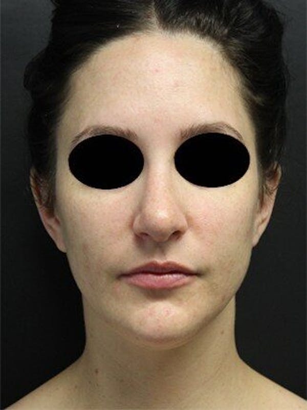Laser Resurfacing