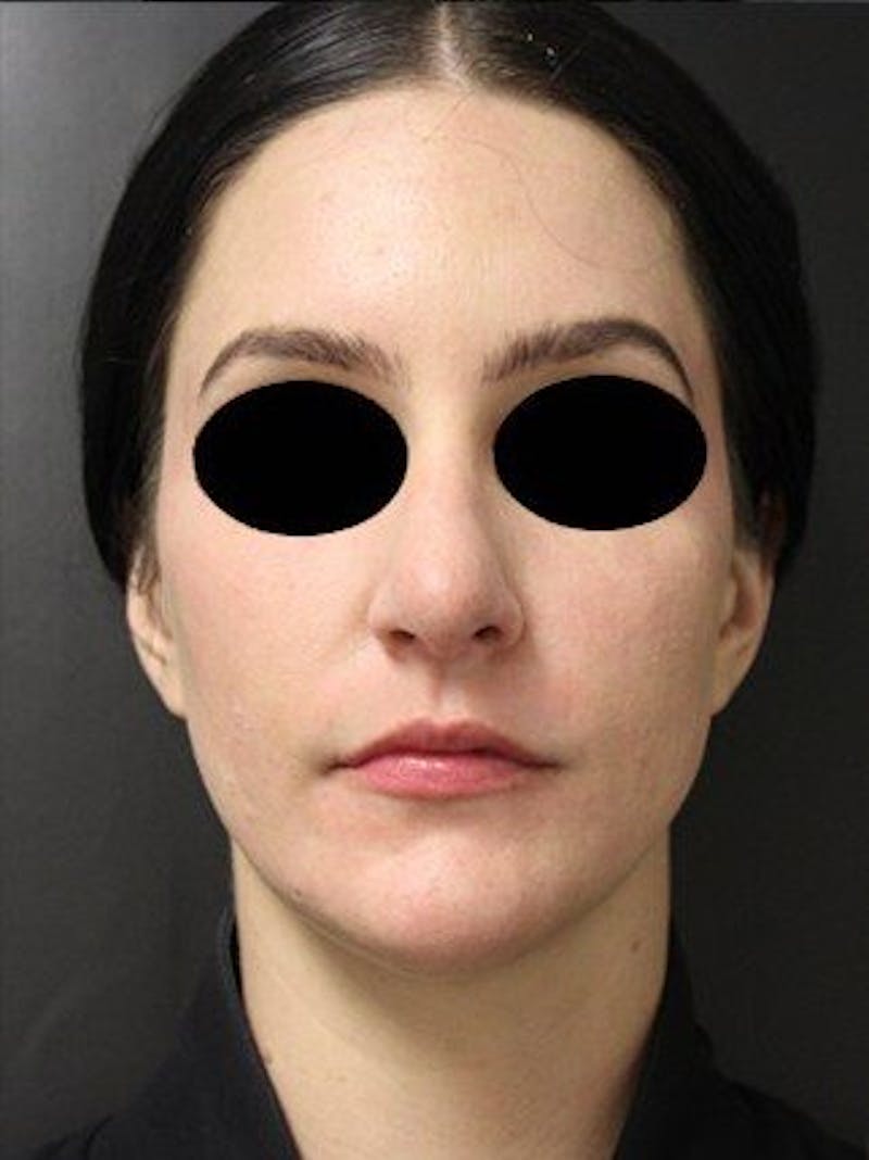 Laser Resurfacing Before & After Gallery - Patient 25139828 - Image 2