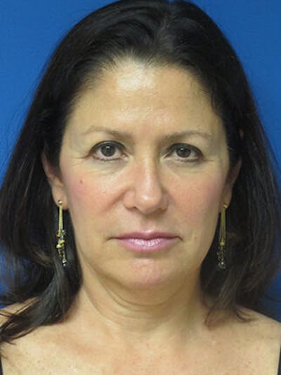 Brow Lift Before & After Gallery - Patient 25139866 - Image 1