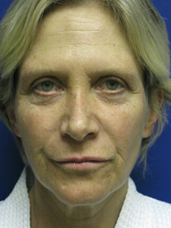 Brow Lift Before & After Gallery - Patient 25139885 - Image 1