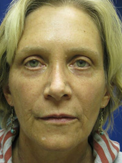 Brow Lift Before & After Gallery - Patient 25139885 - Image 2