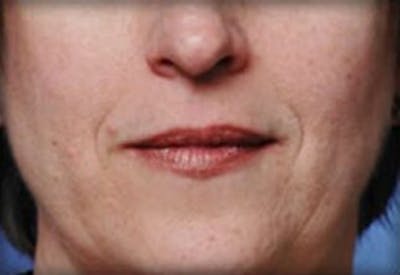 Lip Filler Before & After Gallery - Patient 870644 - Image 1