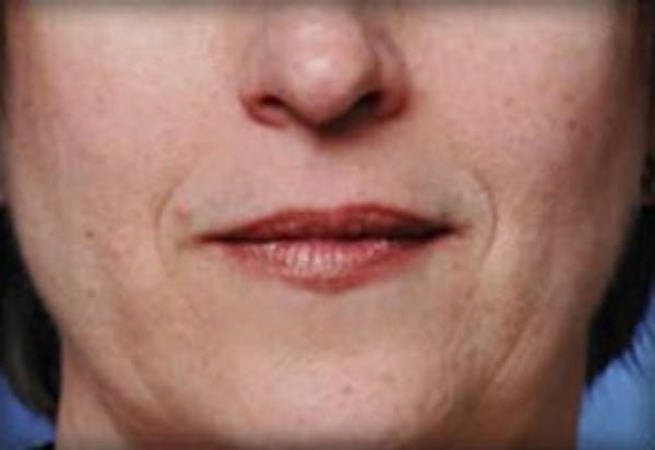 Lip Filler Before & After Gallery - Patient 870644 - Image 1