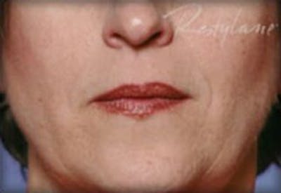 Lip Filler Before & After Gallery - Patient 870644 - Image 2