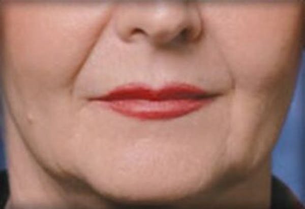Restylane Before & After Gallery - Patient 141186458 - Image 1