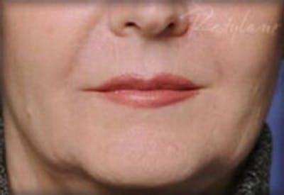 Lip Filler Before & After Gallery - Patient 414199 - Image 1