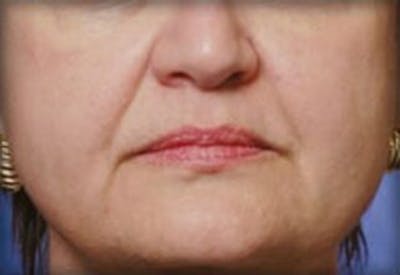 Lip Filler Before & After Gallery - Patient 381365 - Image 1