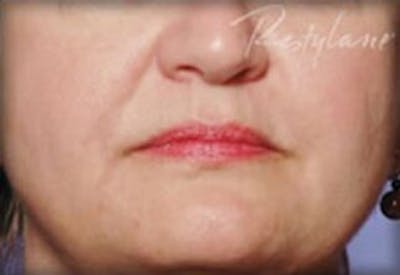 Lip Filler Before & After Gallery - Patient 381365 - Image 2