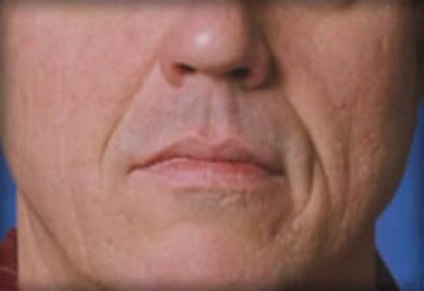 Lip Filler Before & After Gallery - Patient 366821 - Image 1