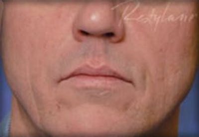 Restylane Before & After Gallery - Patient 141186467 - Image 2