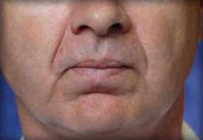 Lip Filler Before & After Gallery - Patient 422234 - Image 1