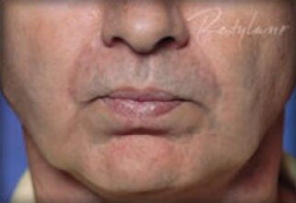Lip Filler Before & After Gallery - Patient 422234 - Image 2