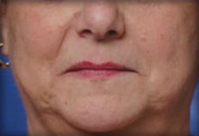 Restylane Before & After Gallery - Patient 141186471 - Image 1