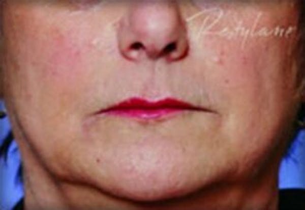 Restylane Before & After Gallery - Patient 141186470 - Image 2
