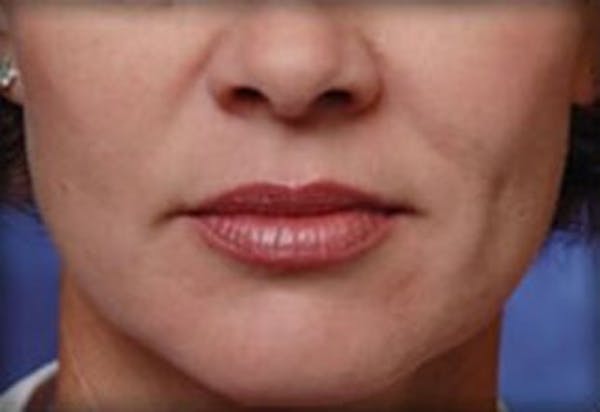 Lip Filler Before & After Gallery - Patient 145888 - Image 2