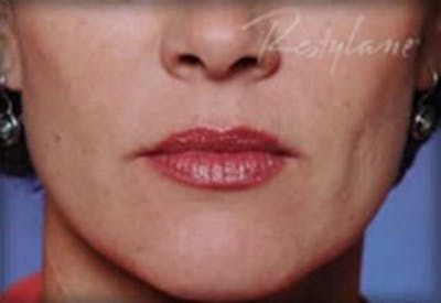 Restylane Before & After Gallery - Patient 141186472 - Image 2