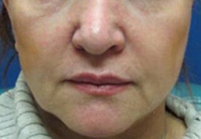 Lip Filler Before & After Gallery - Patient 368353 - Image 1