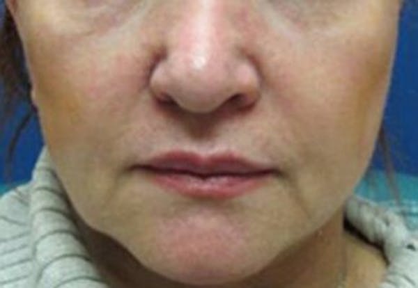 Lip Filler Before & After Gallery - Patient 368353 - Image 1