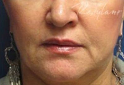 Lip Filler Before & After Gallery - Patient 368353 - Image 2