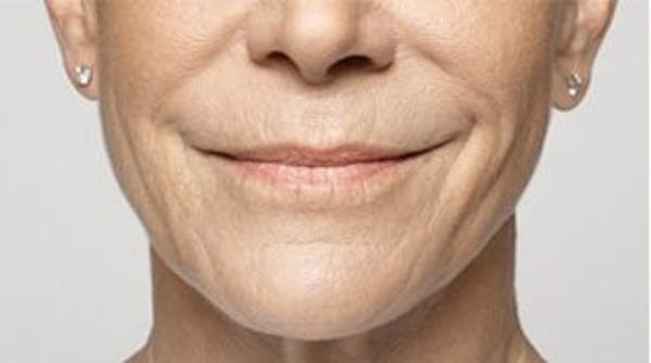 Restylane Before & After Gallery - Patient 141186475 - Image 1