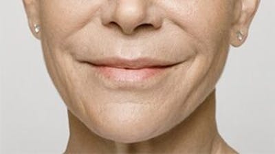 Restylane Before & After Gallery - Patient 141186475 - Image 2