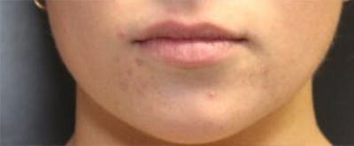 Juvederm Before & After Gallery - Patient 141186455 - Image 1
