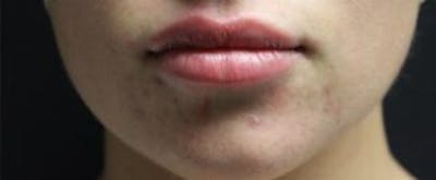 Lip Filler Before & After Gallery - Patient 390308 - Image 2