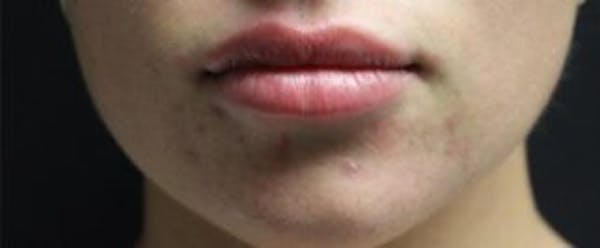 Juvederm Before & After Gallery - Patient 141186455 - Image 2