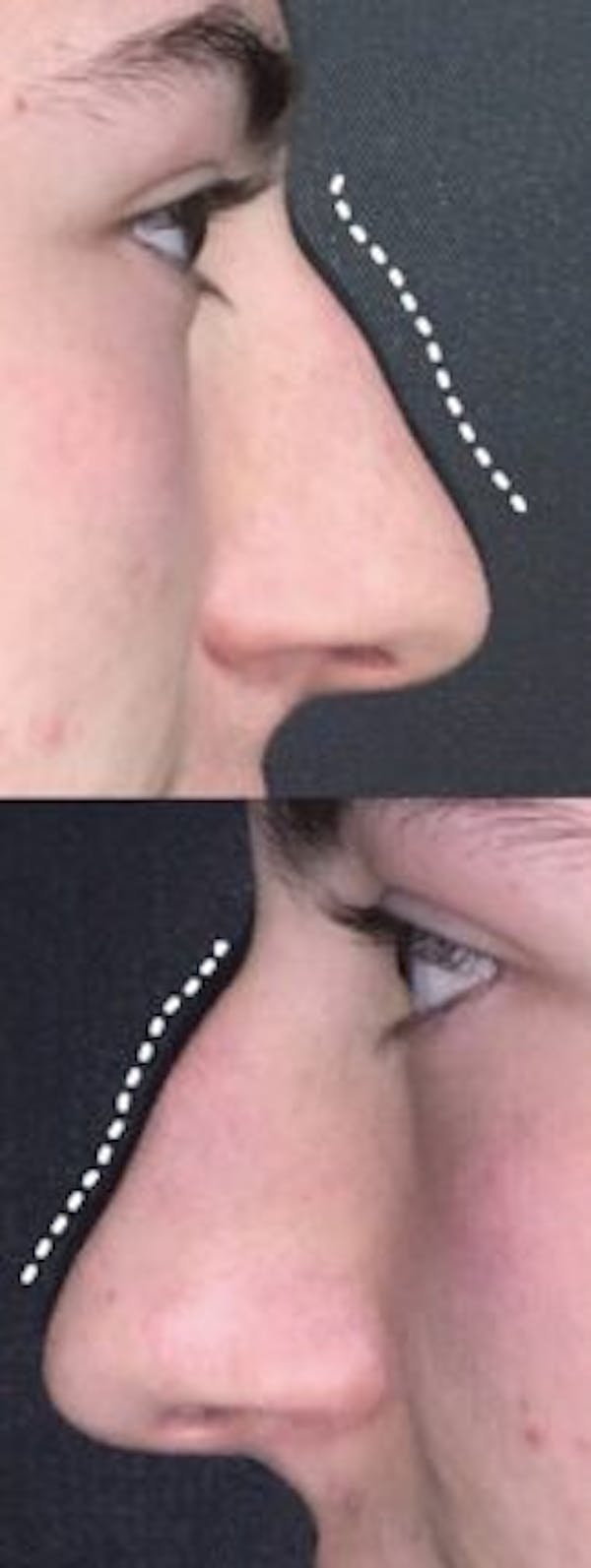 Liquid Rhinoplasty Before & After Gallery - Patient 141186401 - Image 1