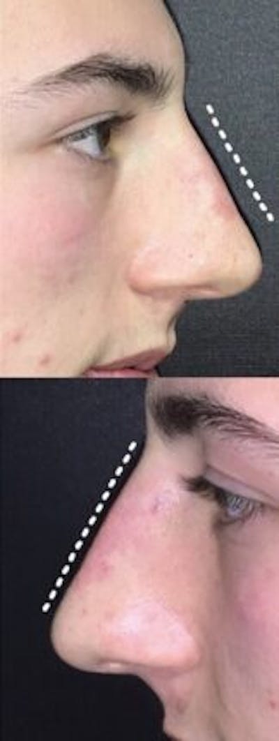 Liquid Rhinoplasty Before & After Gallery - Patient 141186401 - Image 2