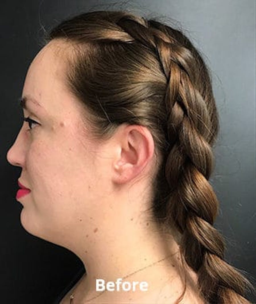 before & after kybella