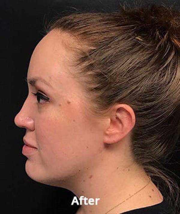 kybella paitent before and after