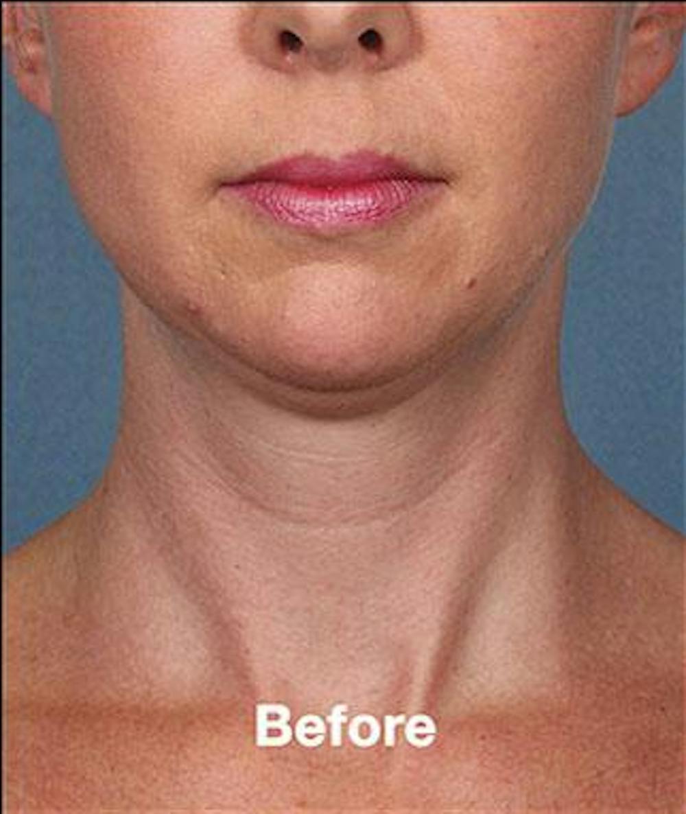 kybella before & after