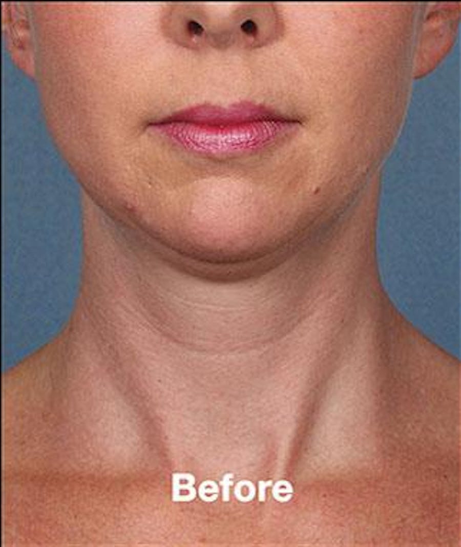 kybella before & after
