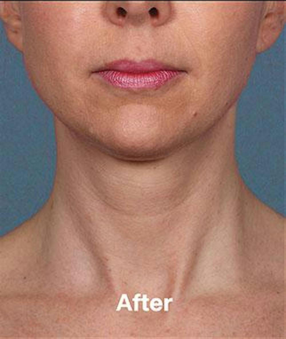 kybella before & after photo