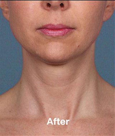 kybella before & after photo