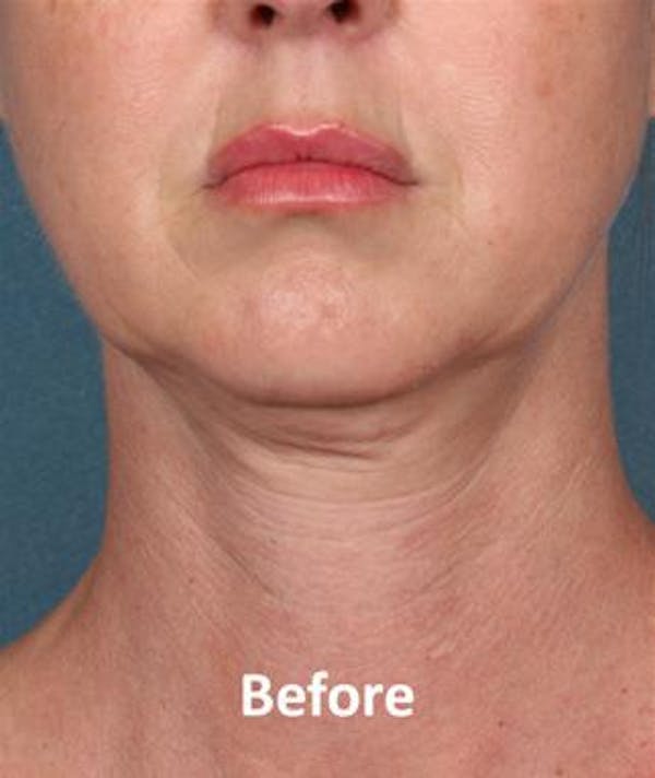 before & after kybella