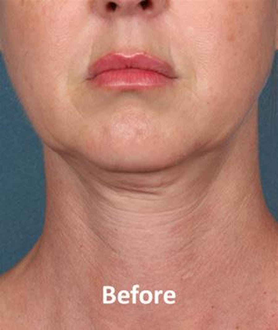 before & after kybella