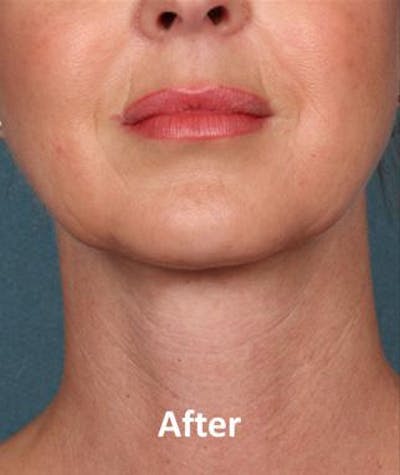 kybella before and after