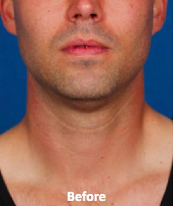 kybella before & after