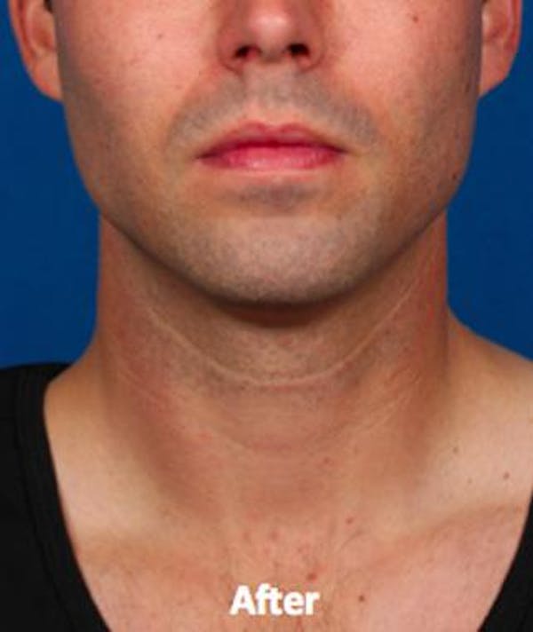 before & after kybella