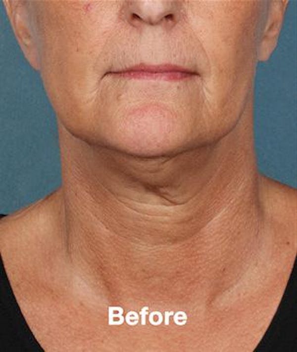 kybella gallery photo