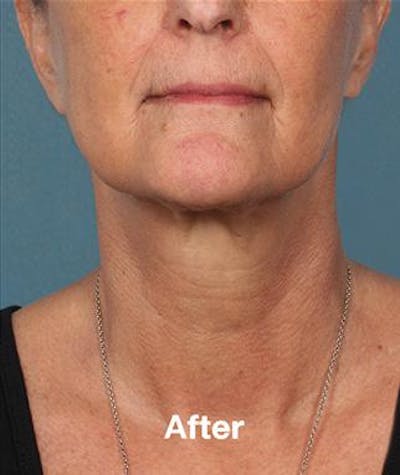 kybella before and after