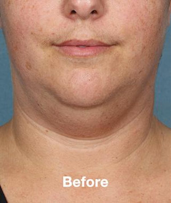 kybella results