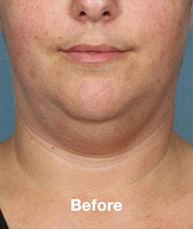 kybella results