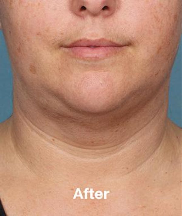 kybella before & after photos
